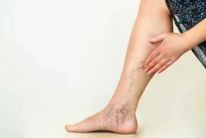 Sclerotherapy in New London, MN - Bloom Medspa