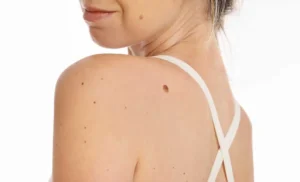 SkinPen Microneedling by Arabella Boutique Med Spa in Oakbrook Terrace, IL