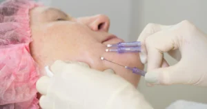 Gloved hands insert PDO threads into the jawline during a non-surgical facial contouring procedure in Spicer, MN
