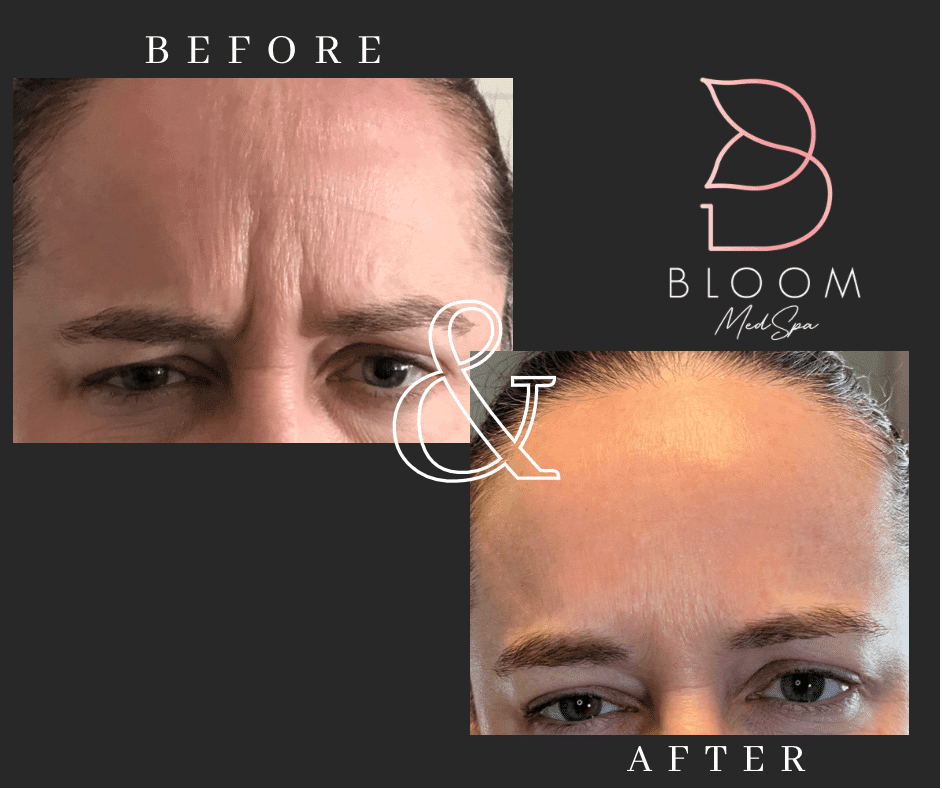 Before and after gallery images Bloom Medspa