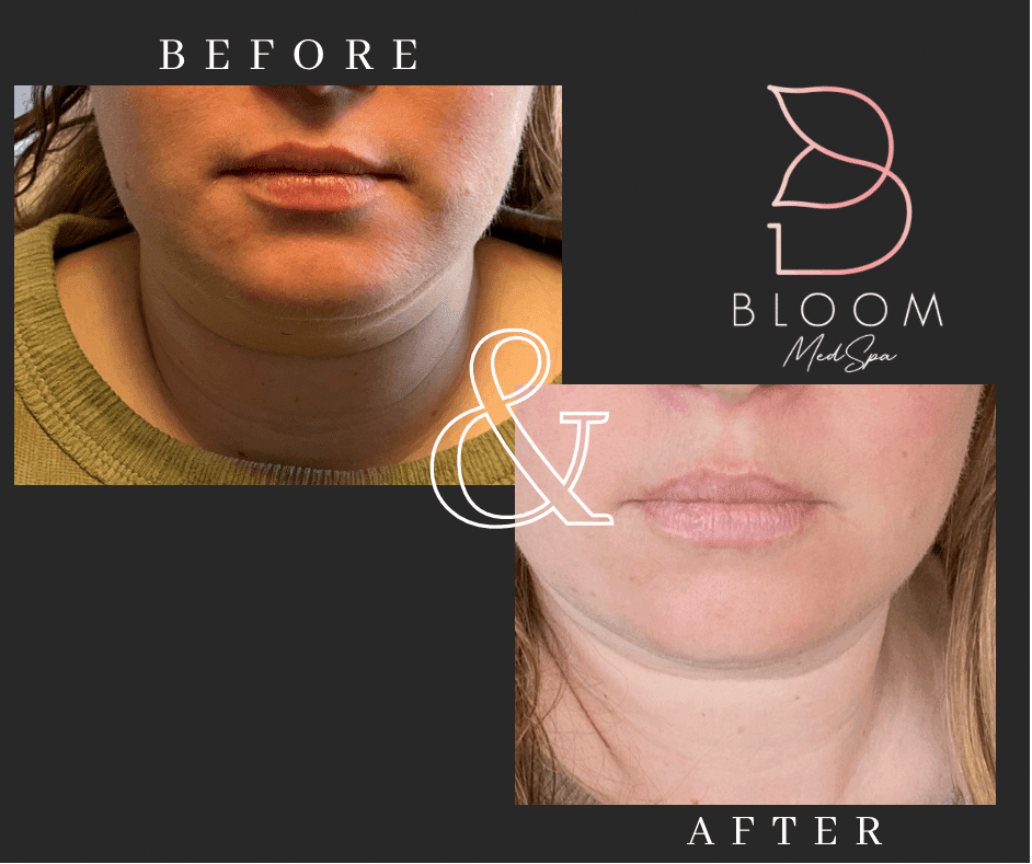 Before and after gallery images Bloom Medspa