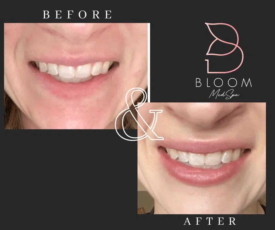 Before and after gallery images Bloom Medspa