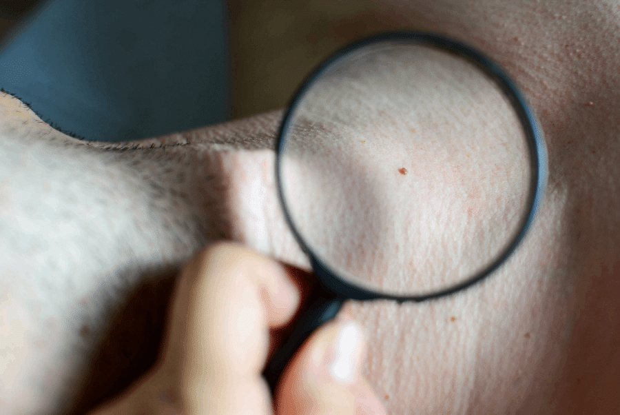Skin Tag removal in London Mn by Bloom Medspa