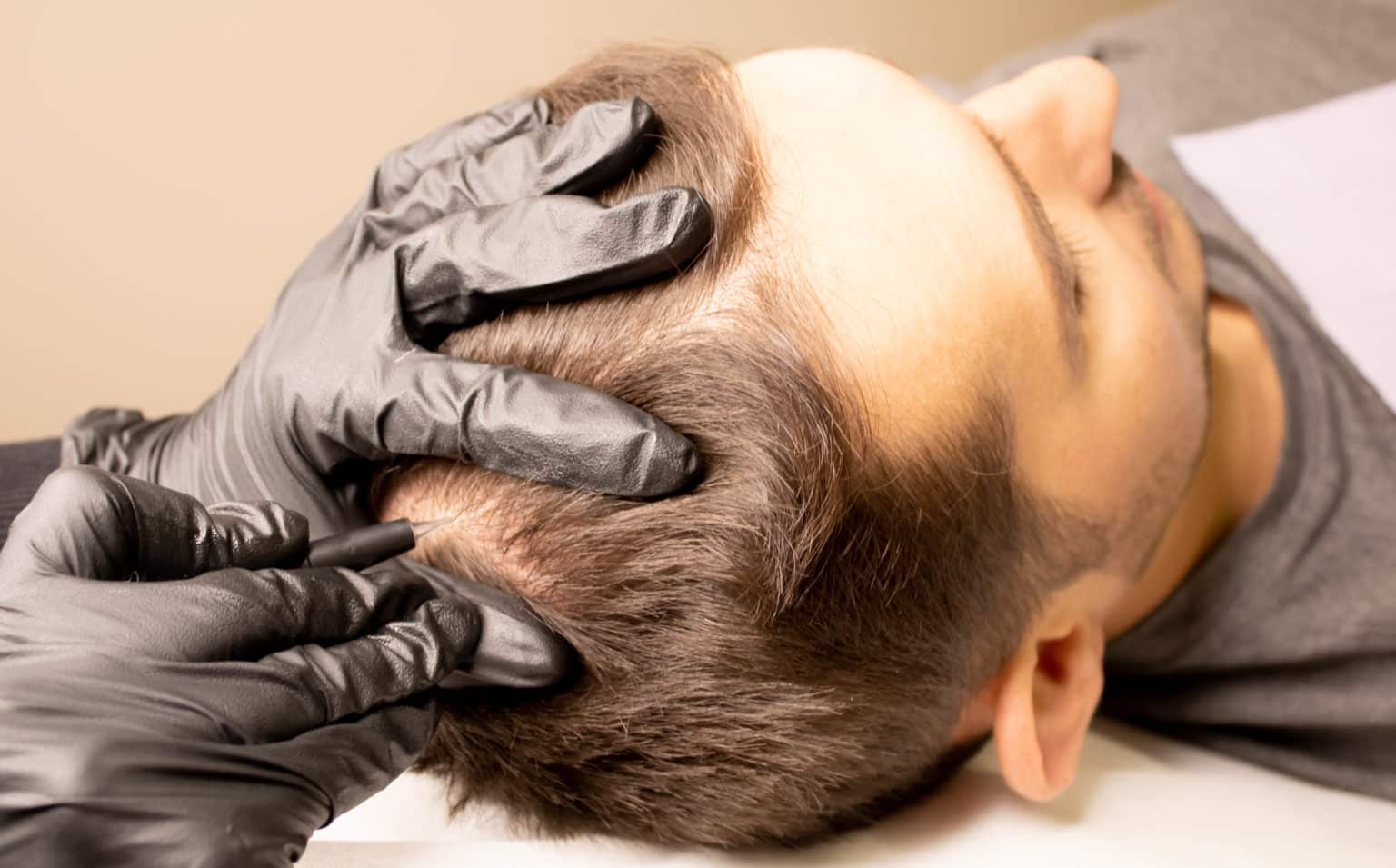 The Best Hair Restoration Method for Men In 2021 - Robb Report