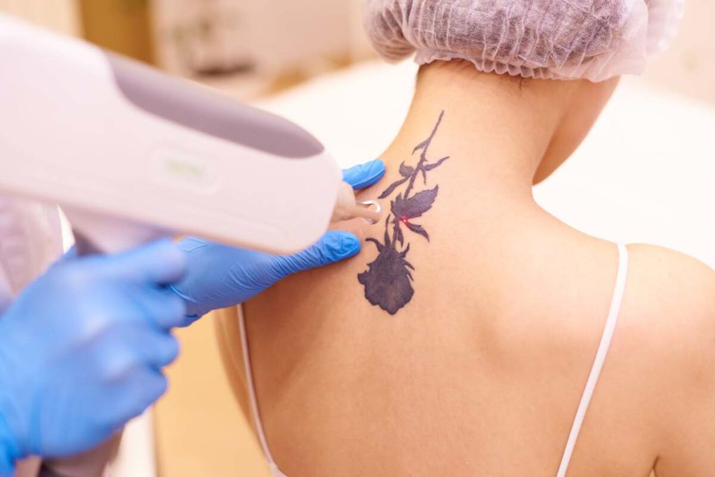 Laser Tattoo Removal by Bloom Medspa in Glenwood MN