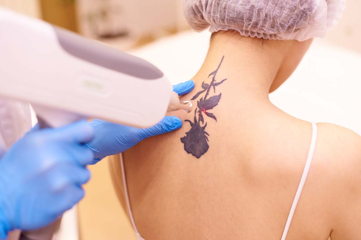 Laser Tattoo Removal by Bloom Medspa in Glenwood MN