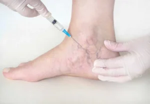 Sclerotherapy by Bloom MedSpa in Spicer, MN
