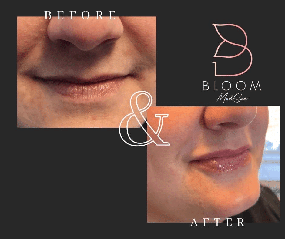 Before and after gallery images Bloom Medspa