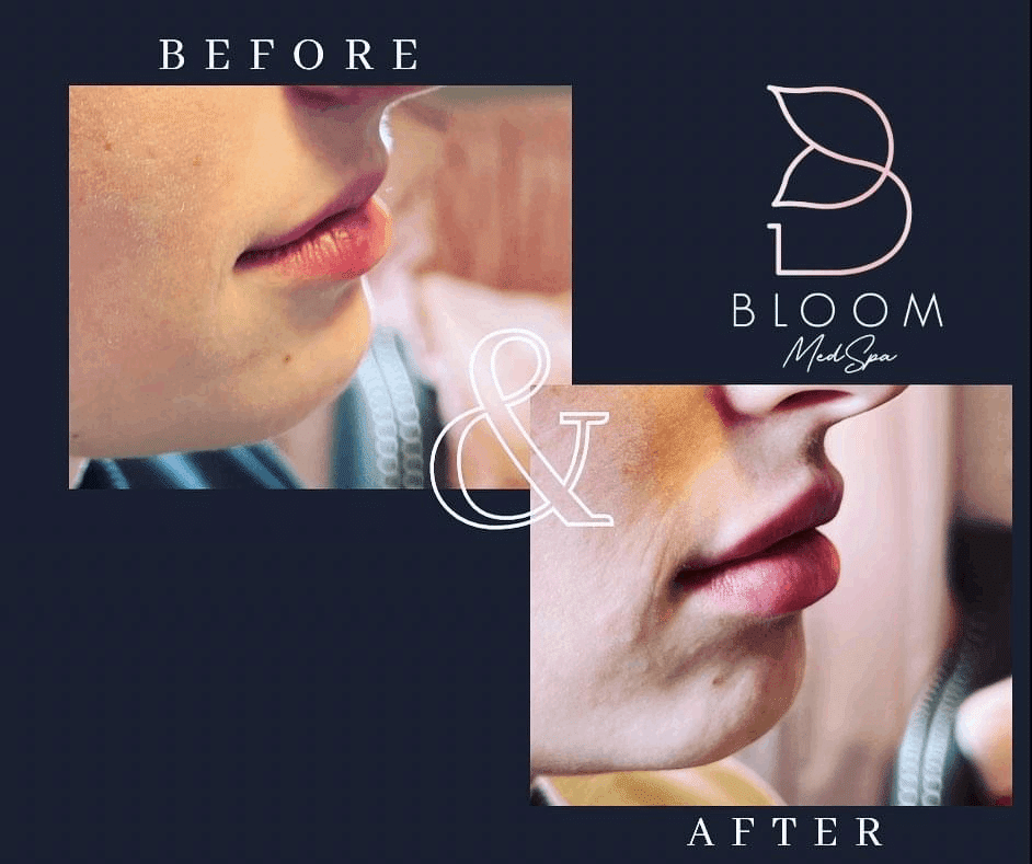 Before and after gallery images Bloom Medspa